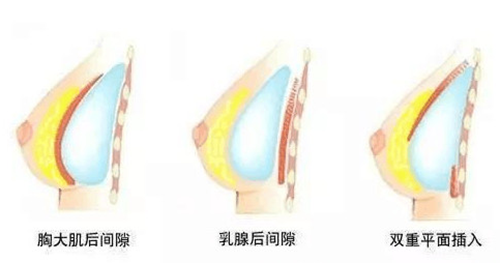 韩国profile普罗菲耳医院假体植入方式