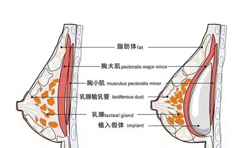 韩国普罗菲尔整形医院郑在皓院长假体隆胸技术好不好