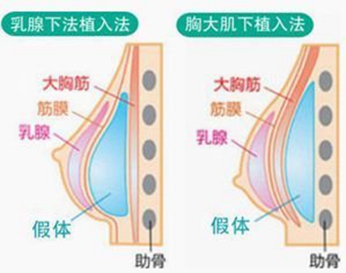 韩国普罗菲尔整形医院郑在皓院长双平面隆胸效果怎么样？