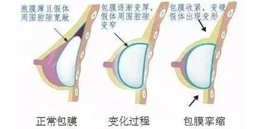 包膜挛缩导致下垂