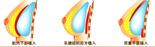 双平面植入方式