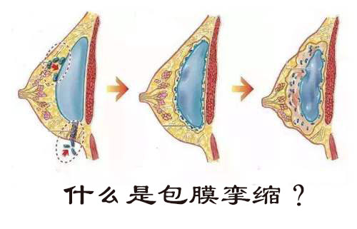 什么是包膜挛缩