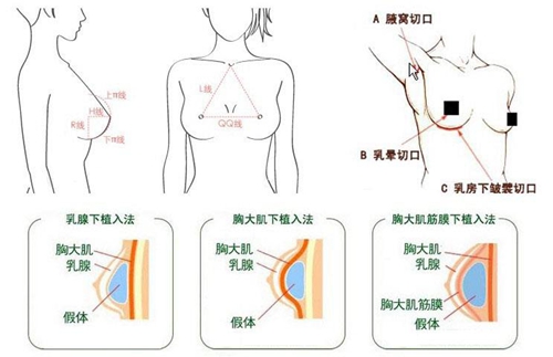 假体隆胸的三种切口